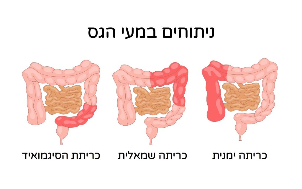 סוגי ניתוחים במעי הגס