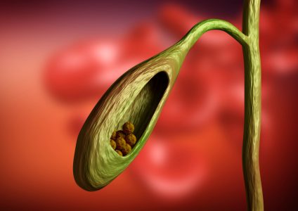 כריתת כיס המרה - ד"ר אבי רשף כירורג