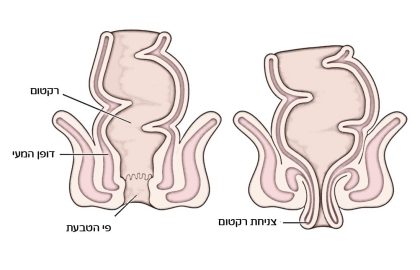צניחת רקטום: הבעיות התפקודיות הנלוות לה