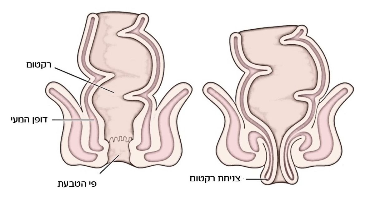 צניחת רקטום: הבעיות התפקודיות הנלוות לה